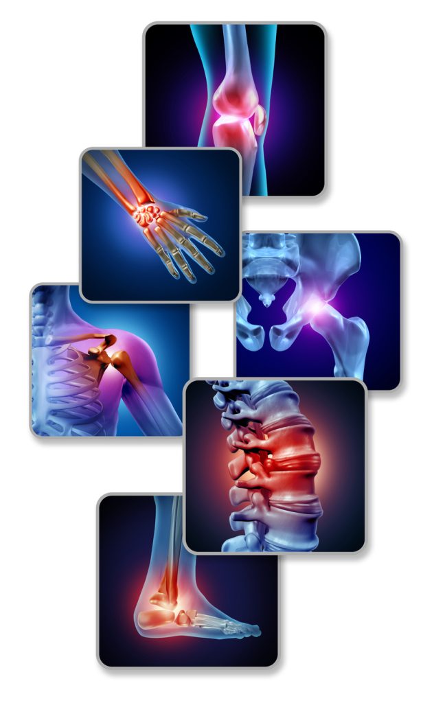 collage of x-rays showing joints with red areas indicating joint pain